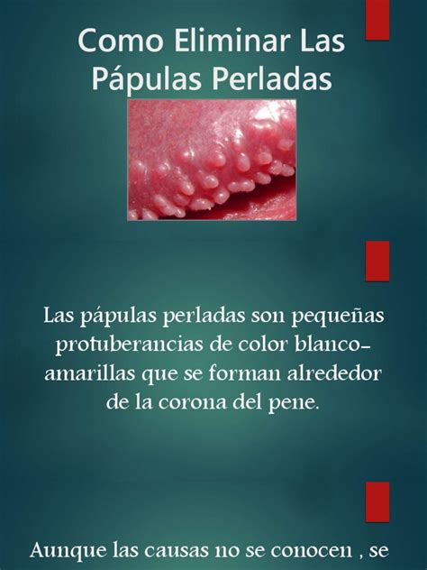 papulas perladas|Pápulas perladas